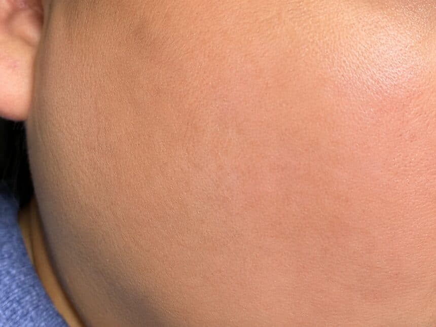Acne Scar Removal after