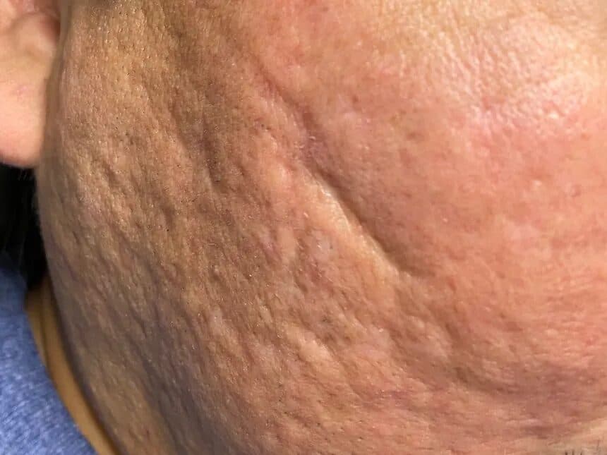 Acne Scar Removal before