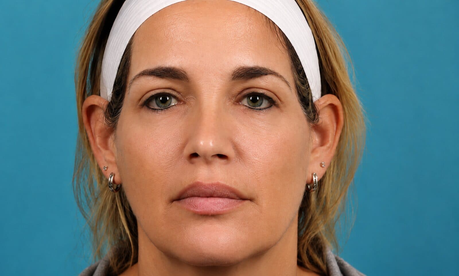Chemical Peel Preview after