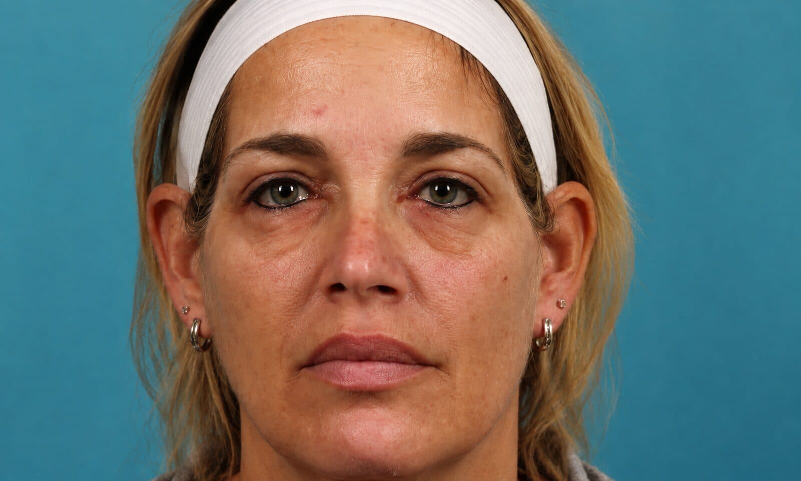 Chemical Peel Preview before