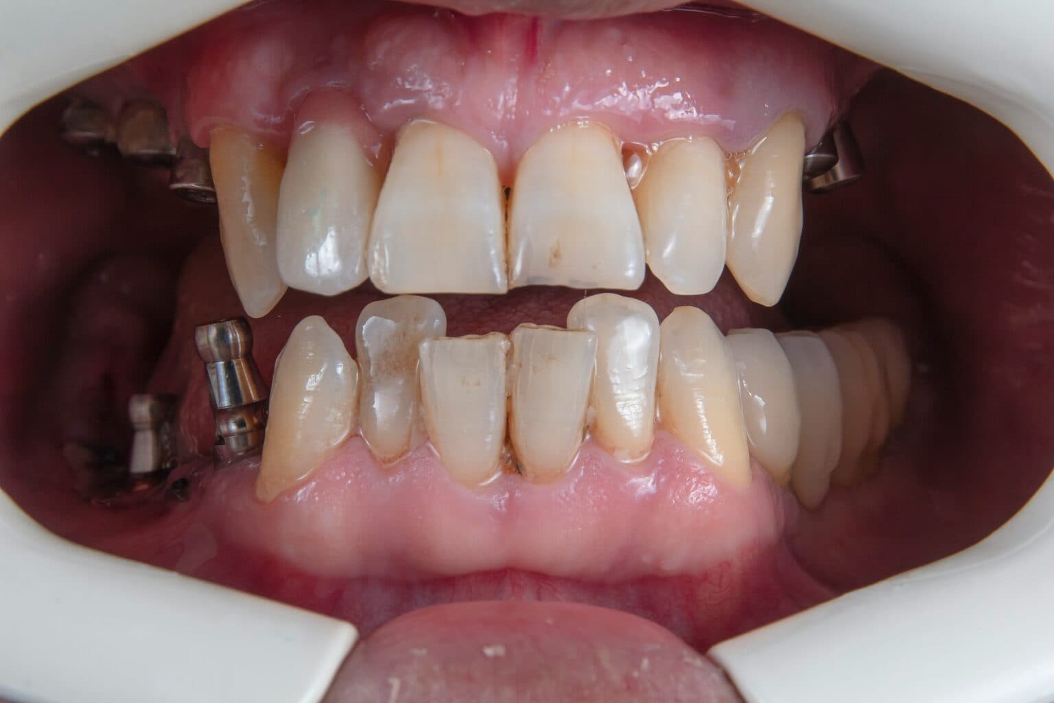 Dental Implant Preview before
