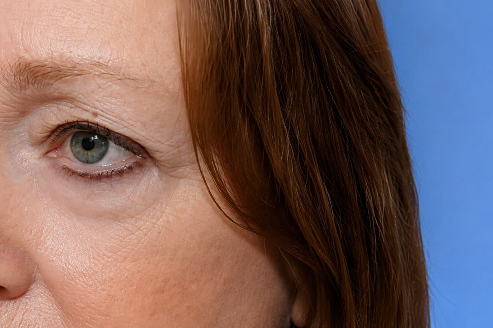 Eyelid Surgery (Blepharoplasty) after