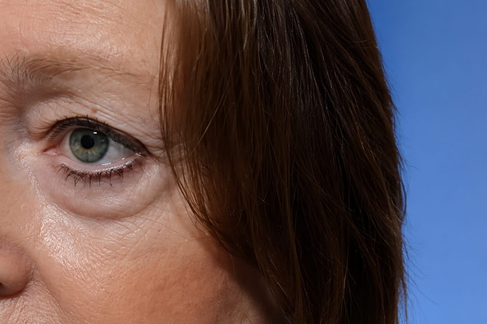 Eyelid Surgery (Blepharoplasty) before