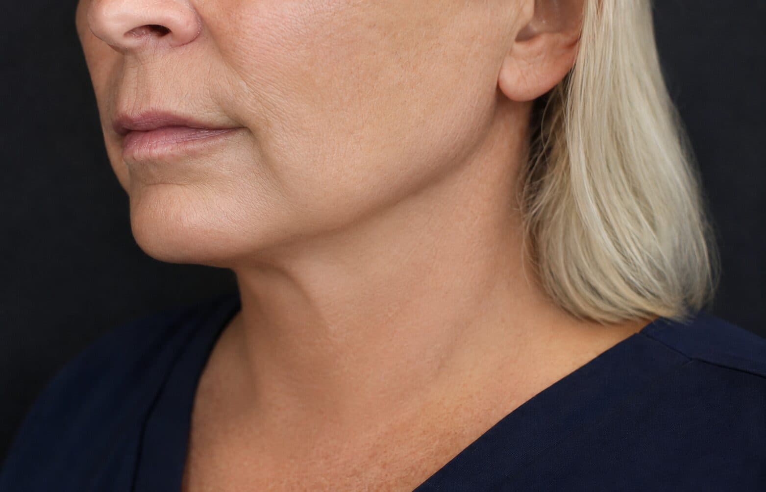 Facelift Preview after