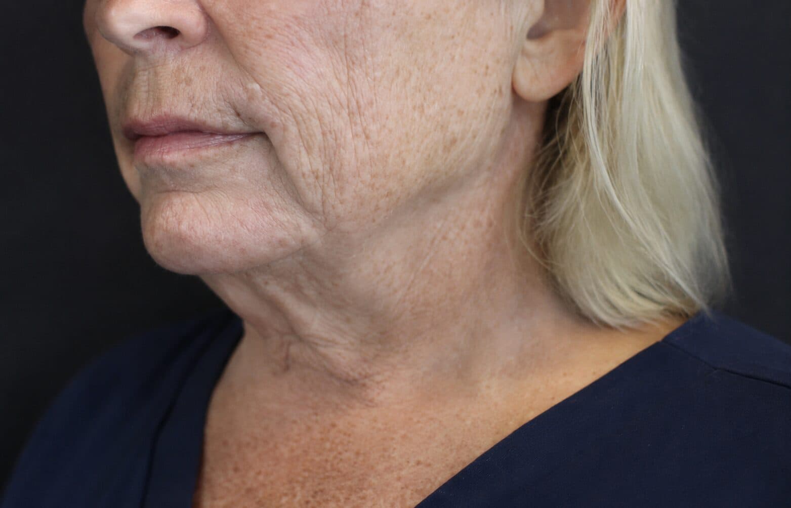 Facelift Preview before