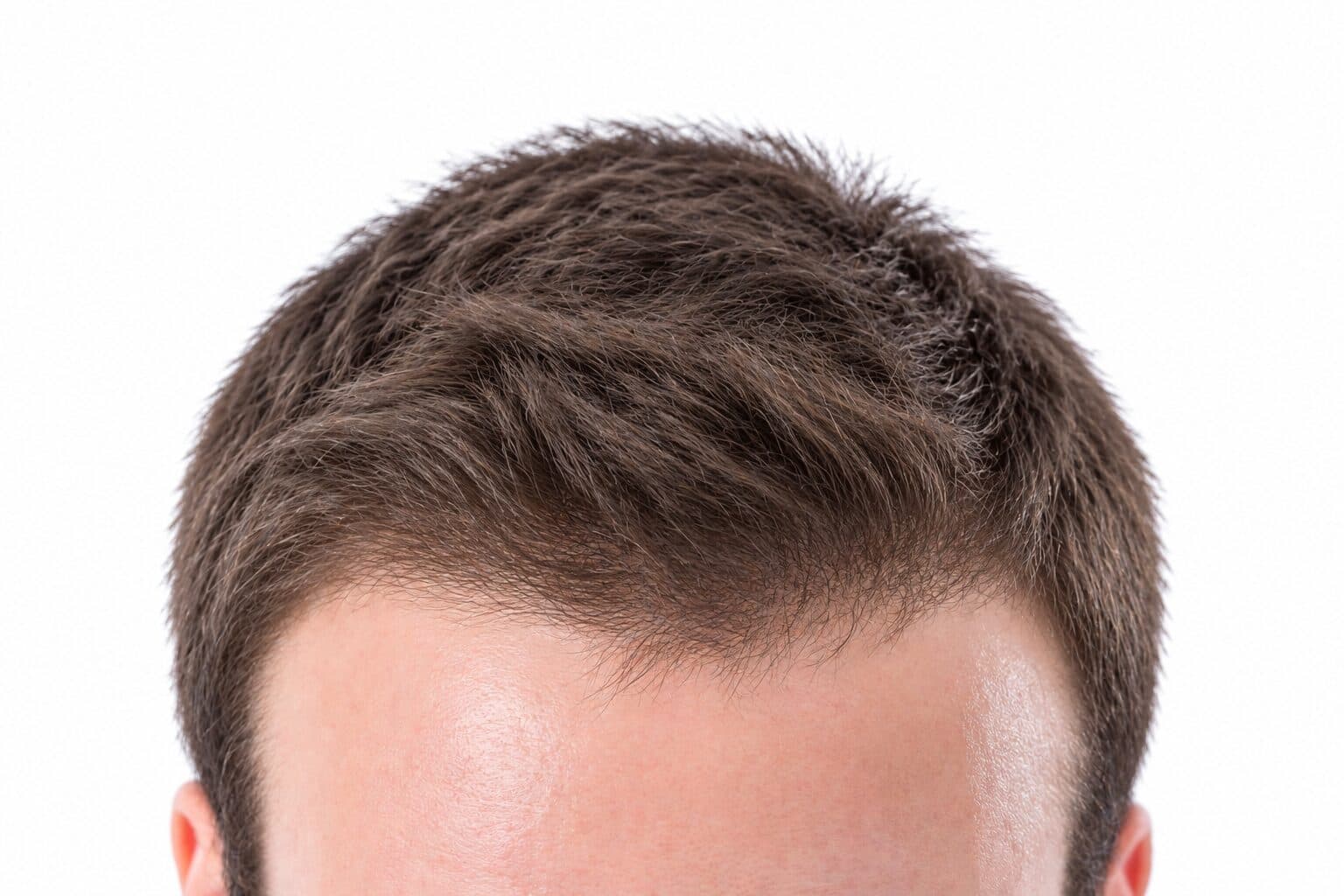 Hair Restoration after