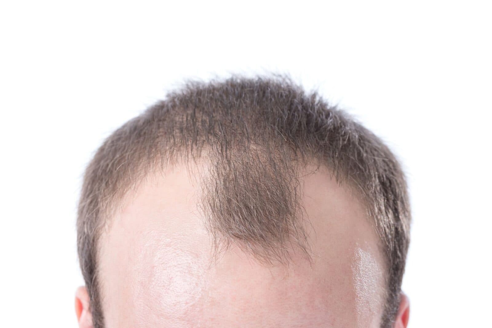 Hair Restoration before
