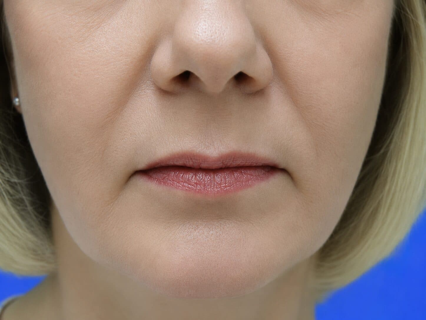 Laser Skin Resurfacing after