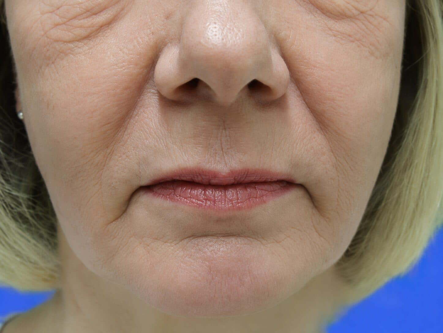 Laser Skin Resurfacing before
