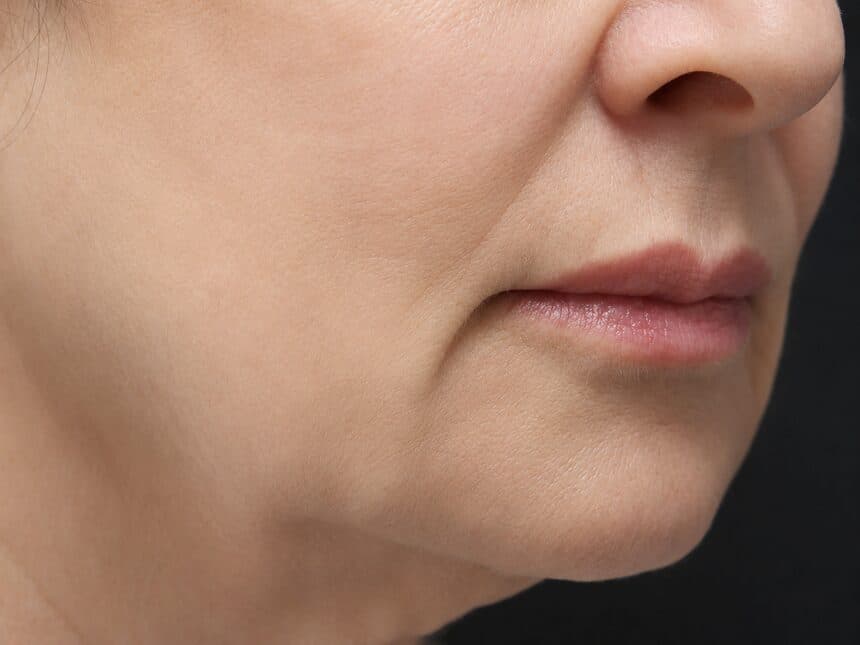 Microneedling Results after