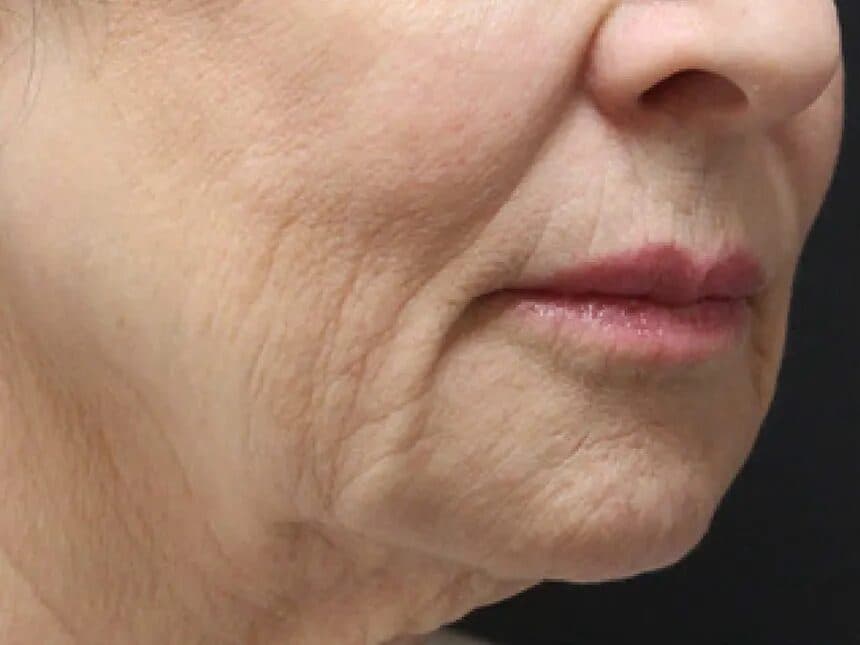 Microneedling Results before