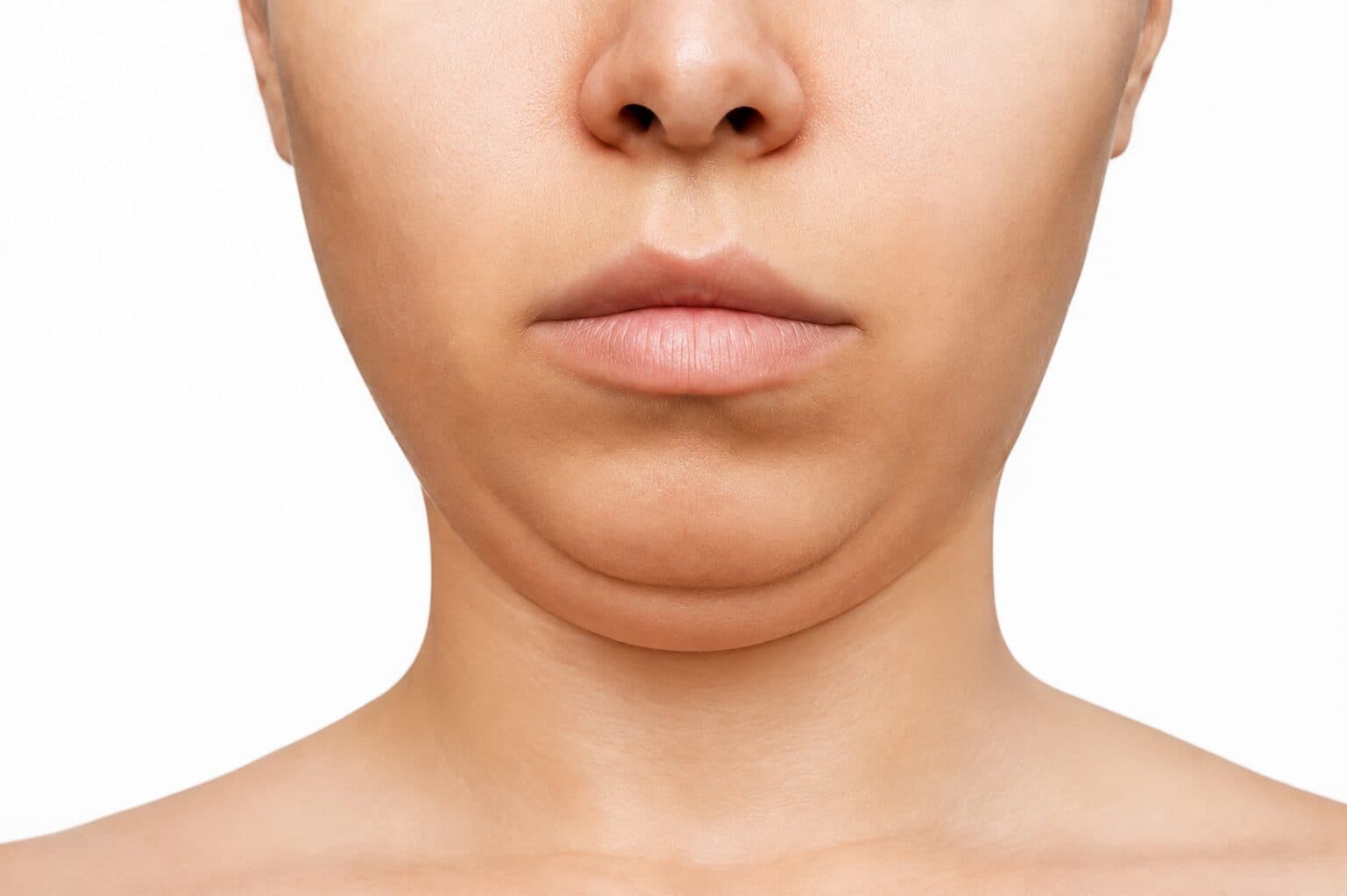 Neck/Chin Liposuction before