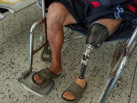 Prosthetic Preview after