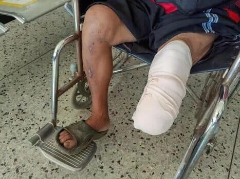 Prosthetic Preview before