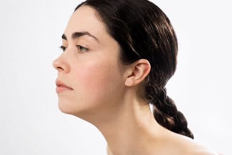 Rosacea Treatment Preview after