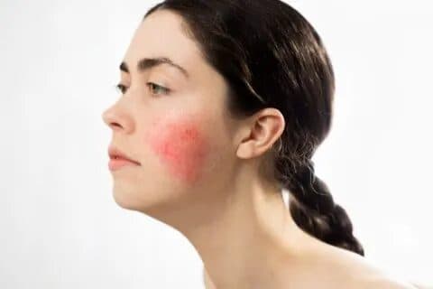 Rosacea Treatment Preview before