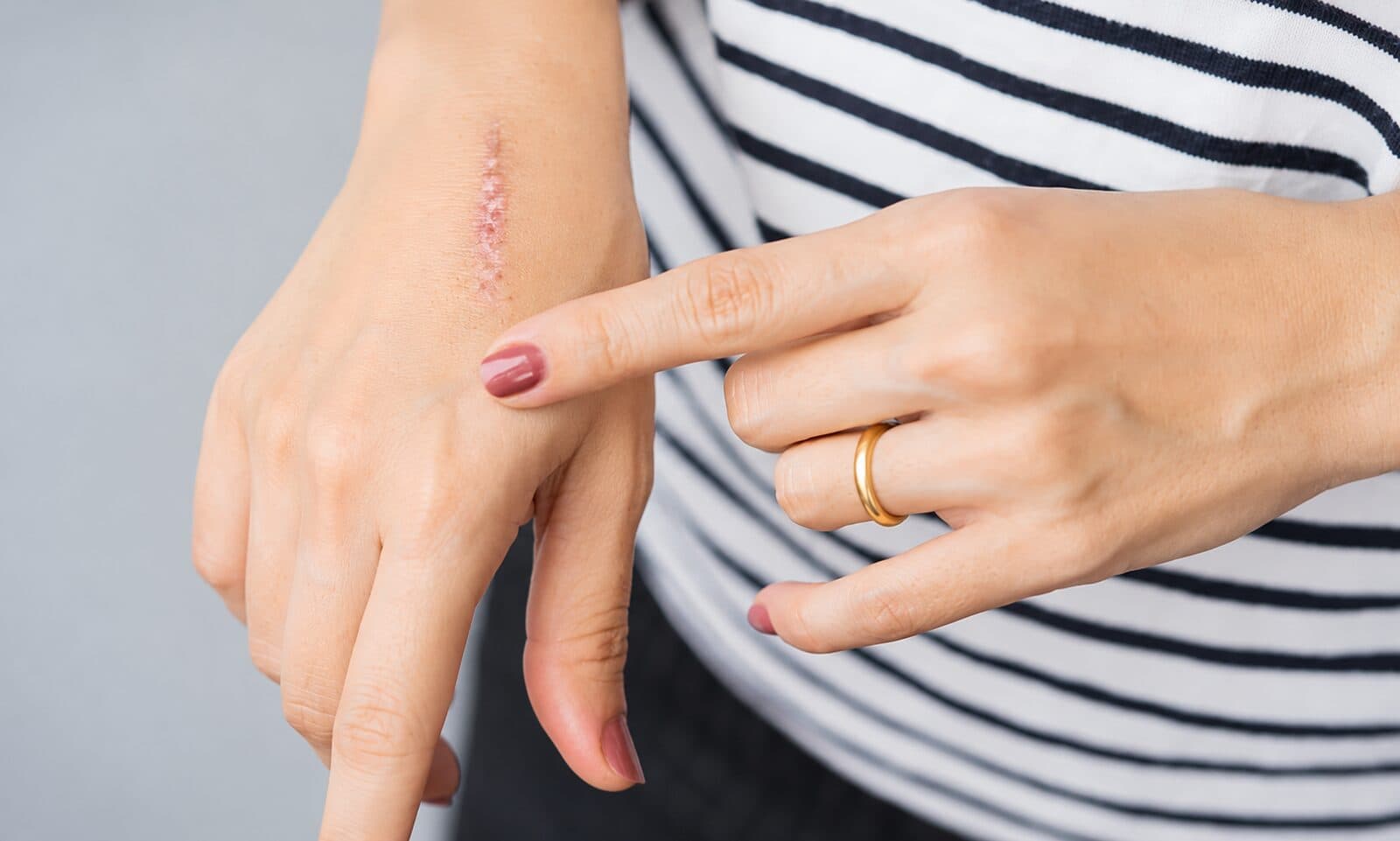 Scar Revision Preview before