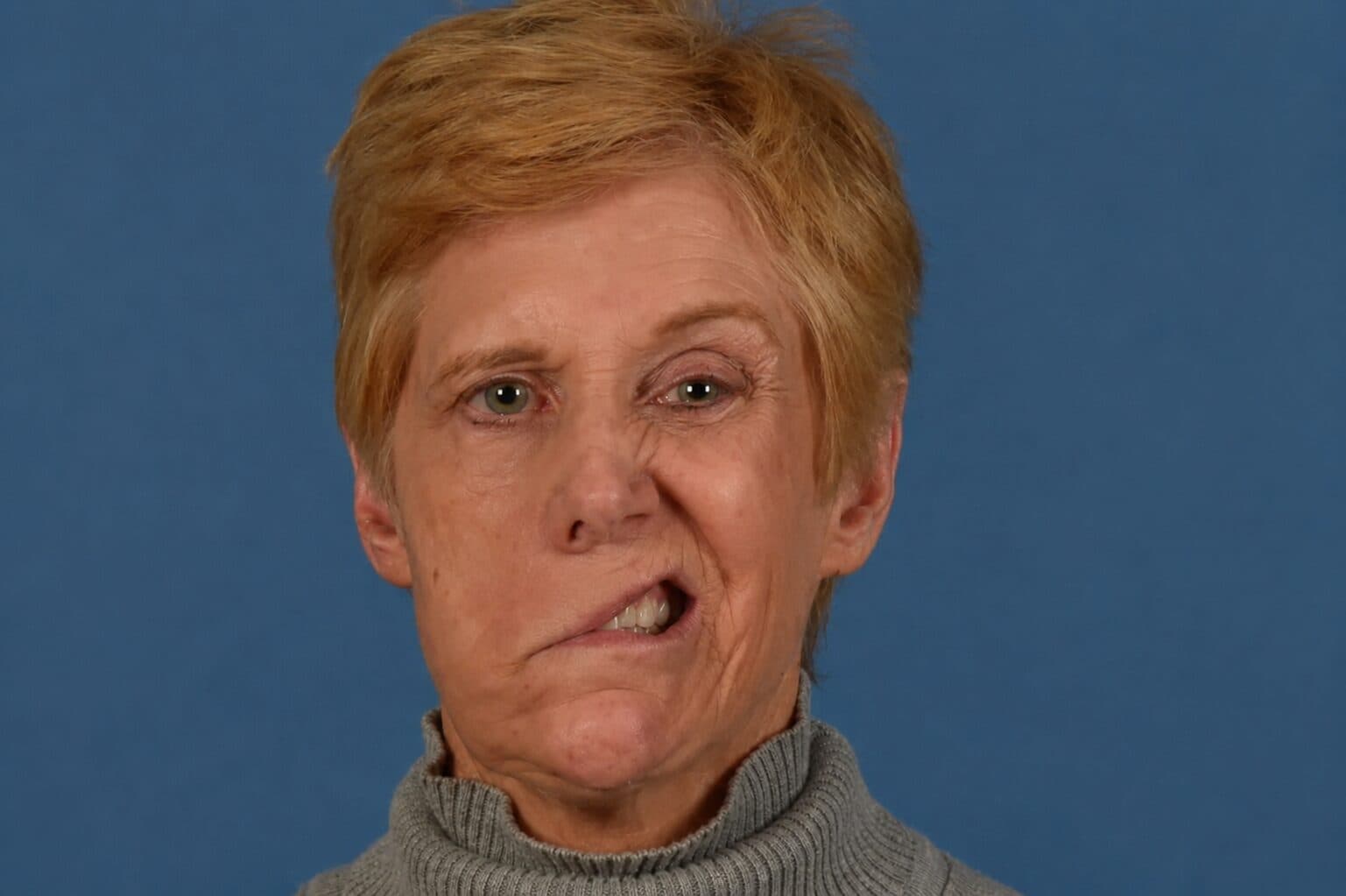 Smile Restoration before