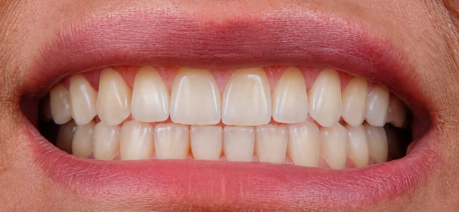 Teeth Straightening after