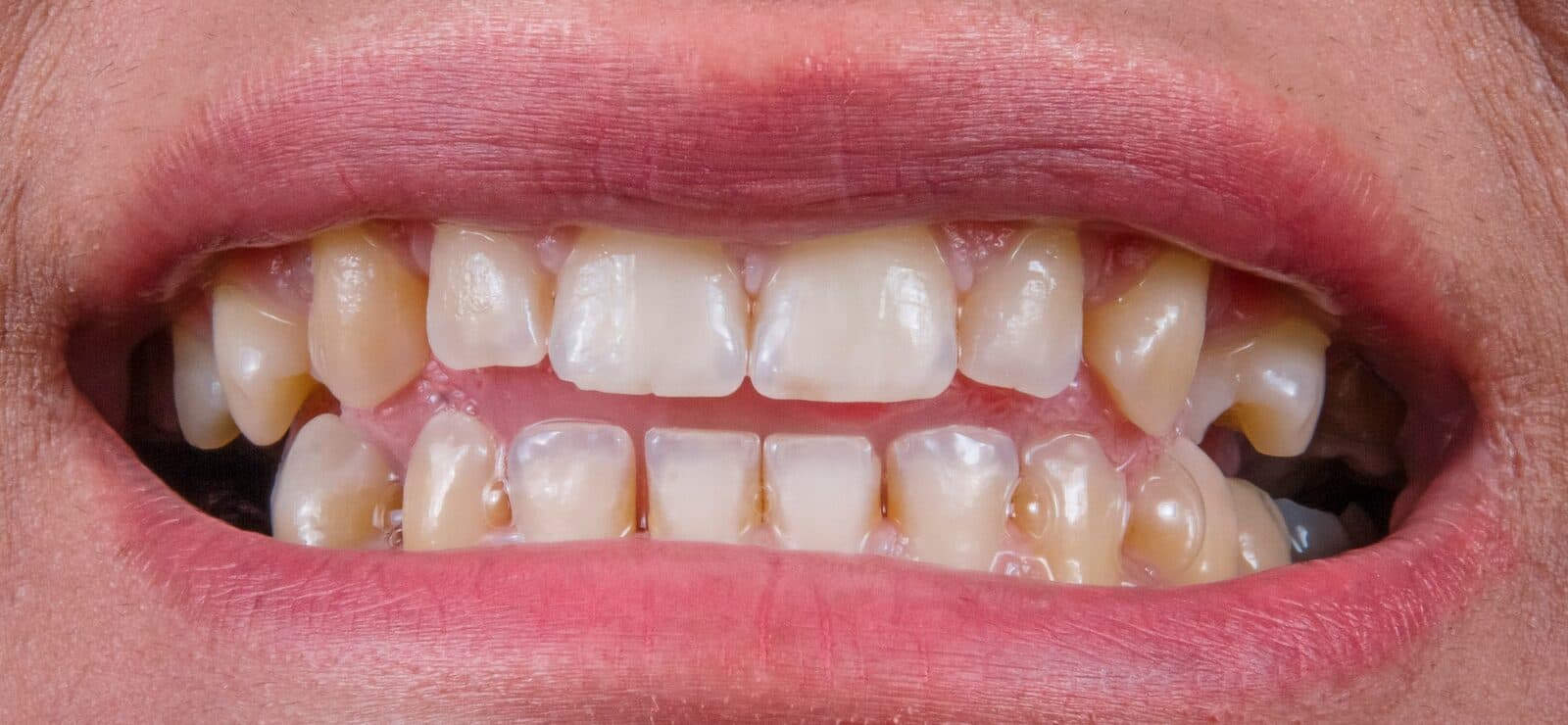 Teeth Straightening before